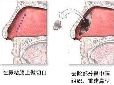 鼻中隔偏曲的危害究竟有多大？