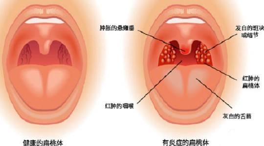 儿童扁桃体肥大应多喝水