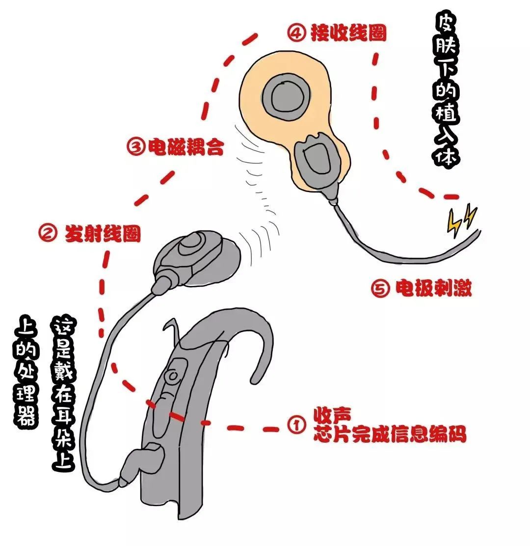 2023年度“让爱发声 民生在行动”人工耳蜗救助项目启动公告