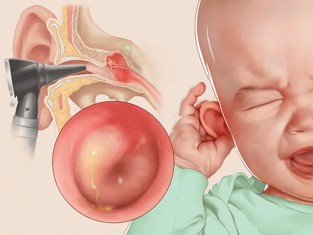 支原体肺炎来势汹汹，孩子的耳朵也跟着遭殃！专家提醒：儿童急性中耳炎需警
