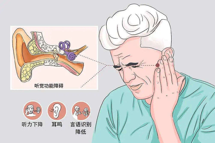 【典型案例】警惕听力倒退：呼吸道感染后如何应对突发性耳聋？