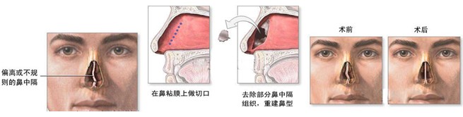 鼻中隔偏曲危害不容小觑,北京耳鼻喉医院专业治疗鼻中隔偏曲