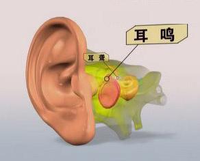 耳鸣的治疗难度大需积极预防
