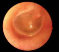 分泌性中耳炎是怎么形成的,有积液吗？