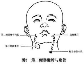 (一)非手术方法可用碘油,三氯醋酸等烧灼瘘管,电灼瘘管以及用盐酸奎宁