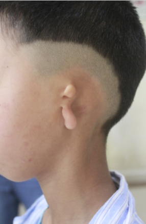 【追踪报道】先天无耳患儿外耳再造前期手术顺利实施