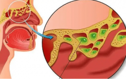 出现这些症状，小心是鼻甲肥大！