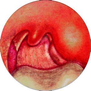 一般所说的扁桃腺是指肉眼可见的颚扁桃体,位于咽峡的侧壁,舌腭弓和咽