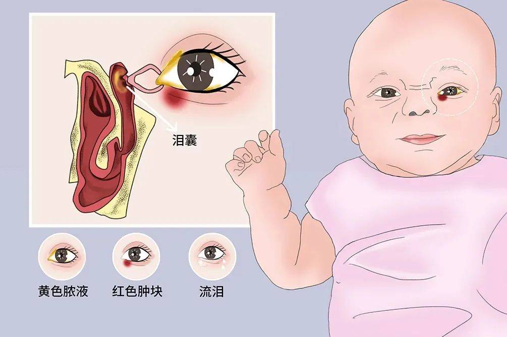 宝宝眼部分泌物多是喝奶粉上火?警惕泪囊炎!